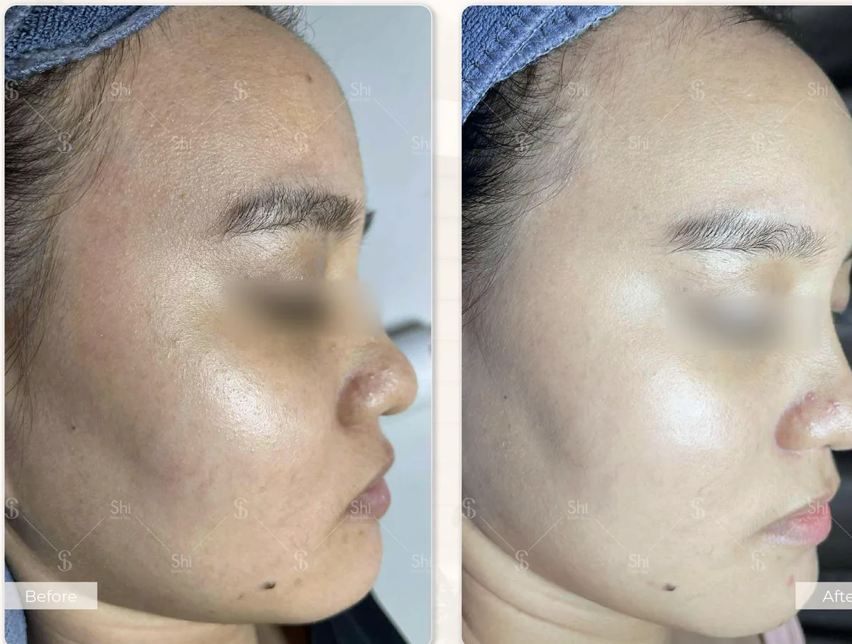 Trước và sau: Kiểm soát mụn chuyên sâu