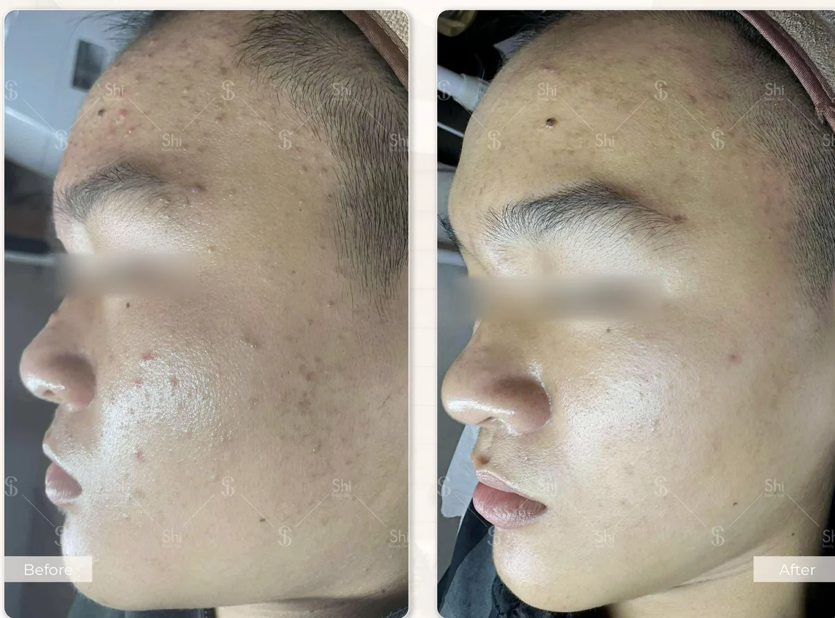 Trước và sau: Detox 4F, sau 1 buổi