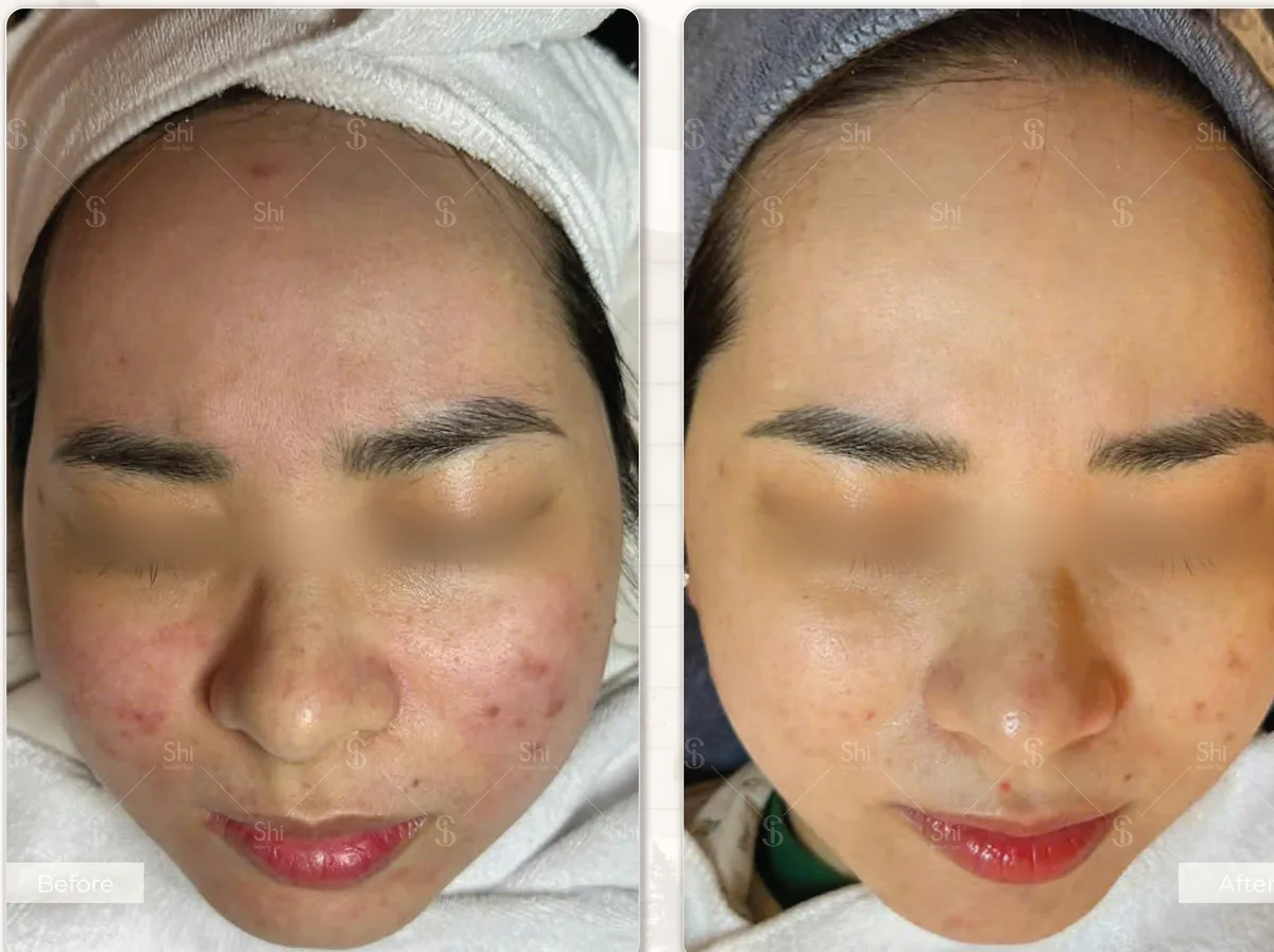 Trước và sau: Detox 4F Extra và Comodex