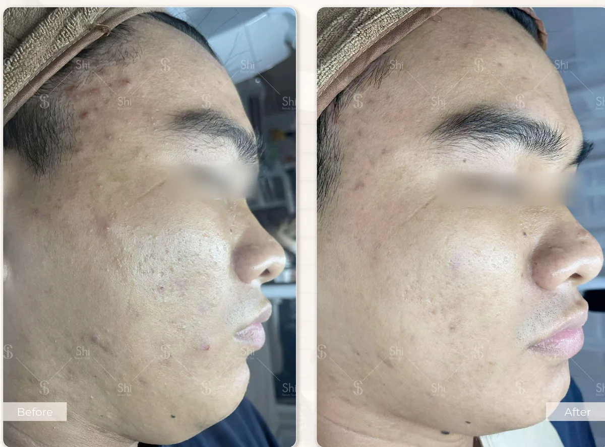 Trước và sau: Liệu trình phục hồi da