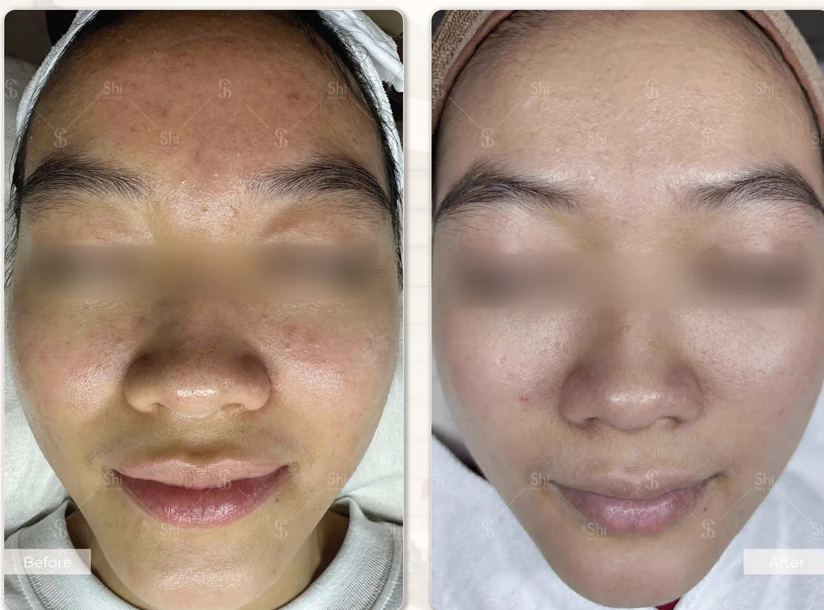 Trước và sau: Detox 4F và Neo Lightening