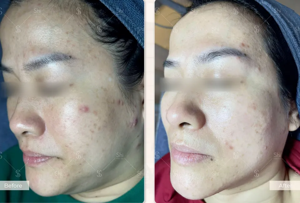 Trước và sau: Shi Acnes