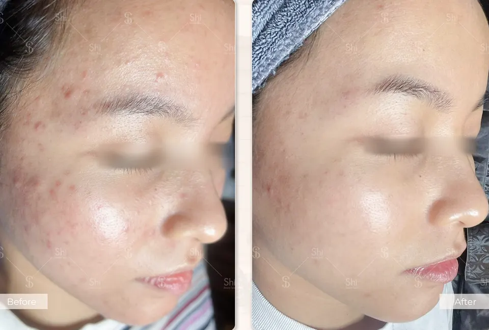 Trước và sau: Shi Acnes