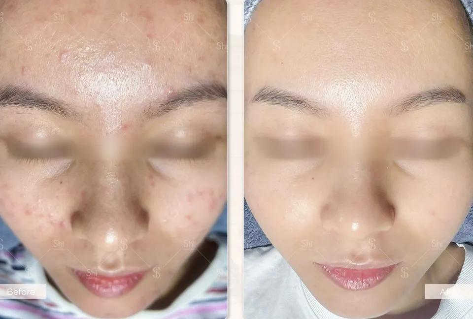 Trước và sau: Shi Acnes