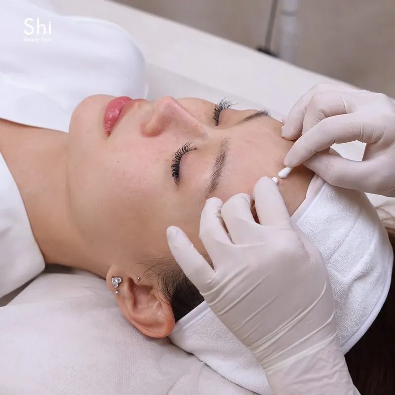 Lấy nhân mụn bằng tăm bông tại Shi